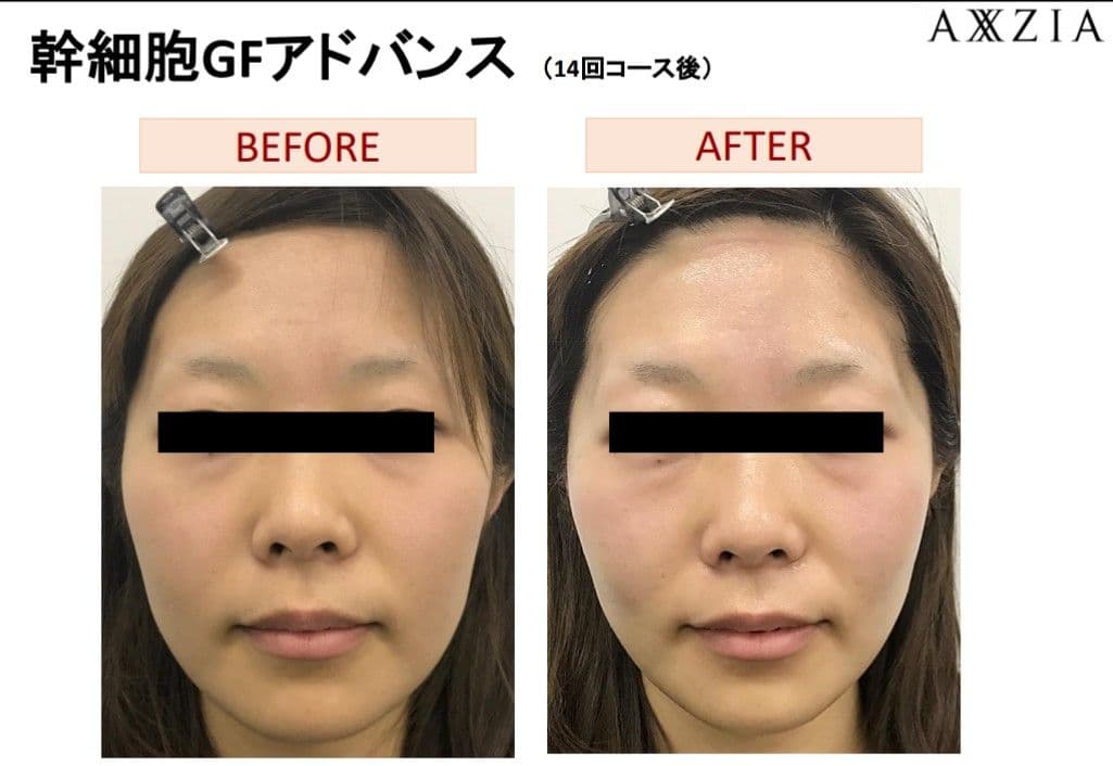 【本物】アクシージア☆GFチャージアドバンス☆美容液導入美肌艶肌水光注射エステ